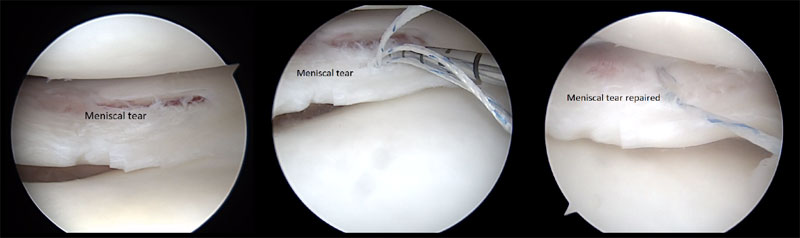 images of meniscus tear -knee sports injuries consultant Mr Aslam Mohammed 25 years experience in treating meniscal tears in high level atheltics   knee injuries